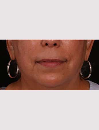 Before Image: Lip Lift And Diamond Procedure - front
