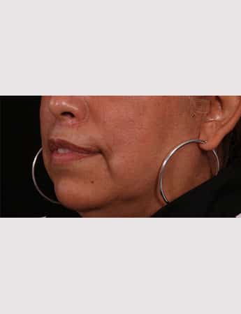 After Image: Lip Lift And Diamond Procedure - left-front-oblique