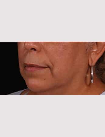Before Image: Lip Lift And Diamond Procedure - left-front-oblique