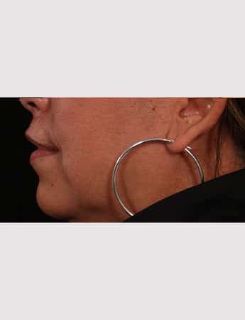 After Image: Lip Lift And Diamond Procedure - left-side
