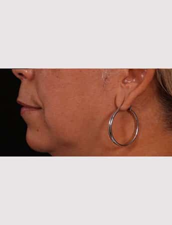 Before Image: Lip Lift And Diamond Procedure - left-side