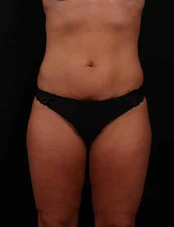 Before Image: Tummy Tuck (Abdominoplasty) - front