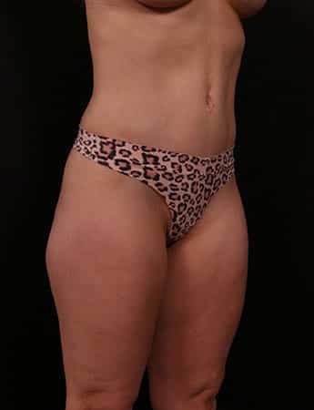After Image: Tummy Tuck (Abdominoplasty) - right-front-oblique