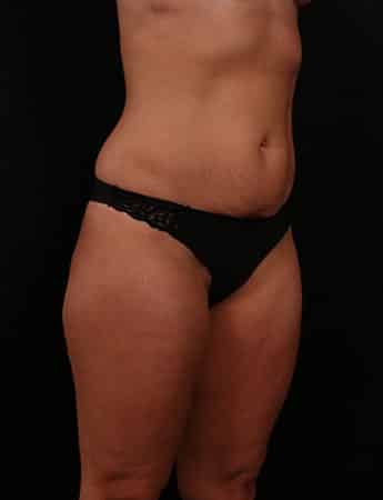Before Image: Tummy Tuck (Abdominoplasty) - right-front-oblique