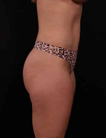 After Image: Tummy Tuck (Abdominoplasty) - right-side