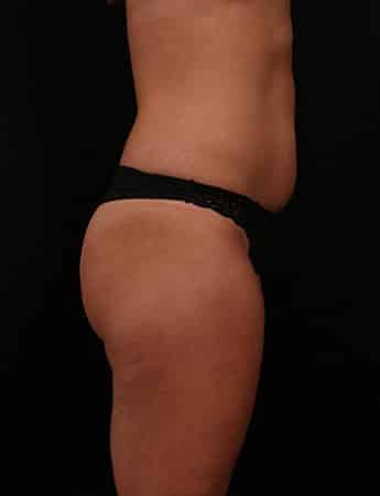 Before Image: Tummy Tuck (Abdominoplasty) - right-side