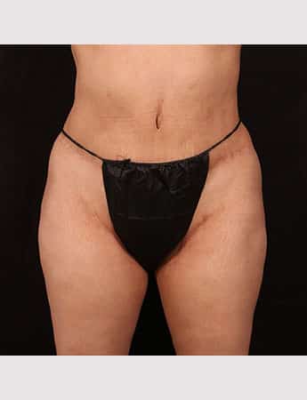 After Image: Inner Thigh Lift - front