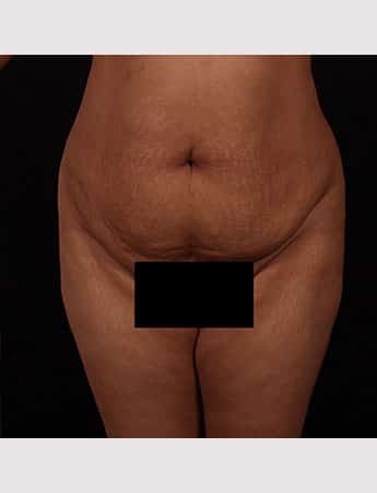 Before Image: Inner Thigh Lift - front