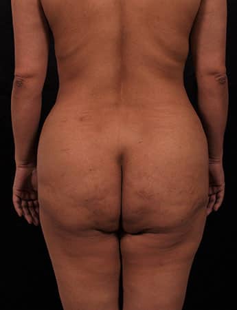 Before Image: Brazilian Butt Lift - back