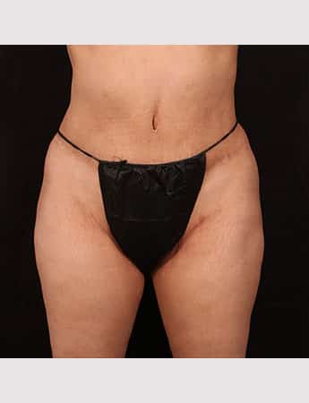 After Image: Tummy Tuck (Abdominoplasty) - front