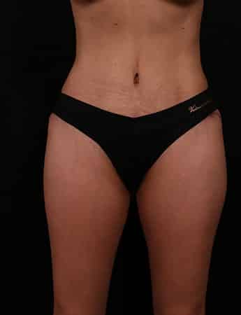 After Image: Tummy Tuck (Abdominoplasty) - front