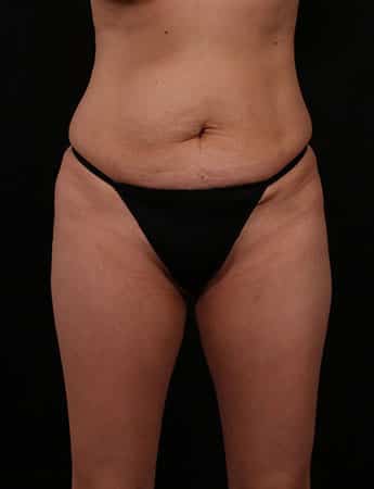 Before Image: Tummy Tuck (Abdominoplasty) - front