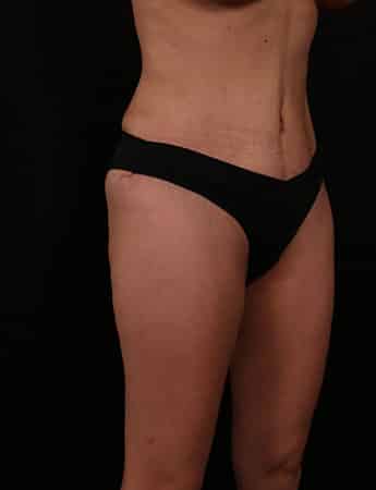 After Image: Tummy Tuck (Abdominoplasty) - right-front-oblique