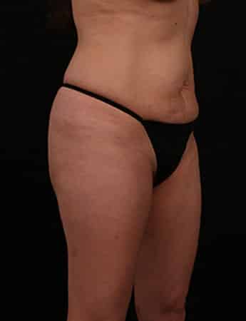 Before Image: Tummy Tuck (Abdominoplasty) - right-front-oblique