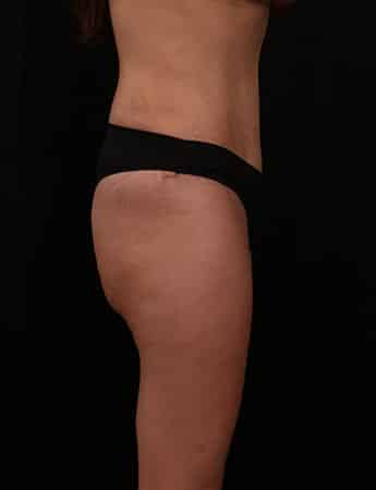 After Image: Tummy Tuck (Abdominoplasty) - right-side