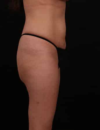 Before Image: Tummy Tuck (Abdominoplasty) - right-side