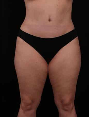 After Image: Tummy Tuck (Abdominoplasty) - front