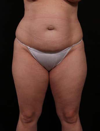 Before Image: Tummy Tuck (Abdominoplasty) - front