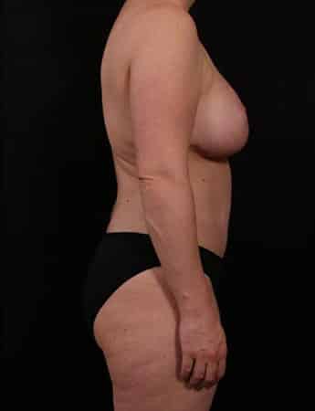 After Image: Mommy Makeover - right-side