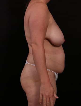 Before Image: Mommy Makeover - right-side