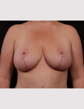 After Image: Breast Reduction - front