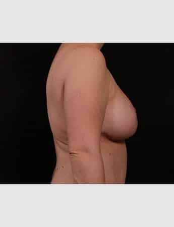 After Image: Breast Reduction - right-side