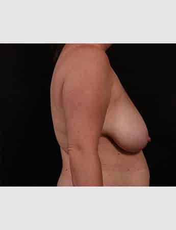 Before Image: Breast Reduction - right-side