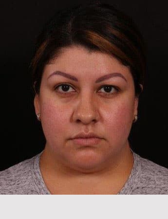 Before Image: Buccal Fat Removal - front
