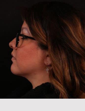 After Image: Neck Liposuction - left-side