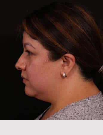 Before Image: Neck Liposuction - left-side