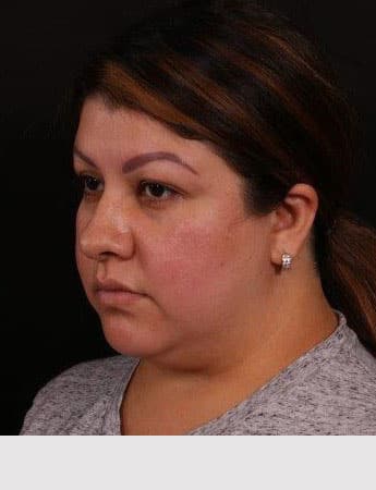 Before Image: Neck Liposuction - left-front-oblique