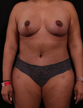 After Image: Mommy Makeover - front
