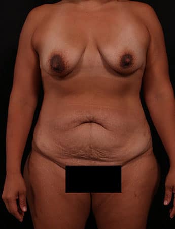 Before Image: Mommy Makeover - front