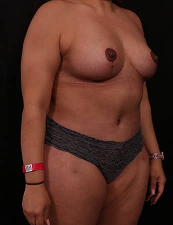 After Image: Mommy Makeover - right-front-oblique