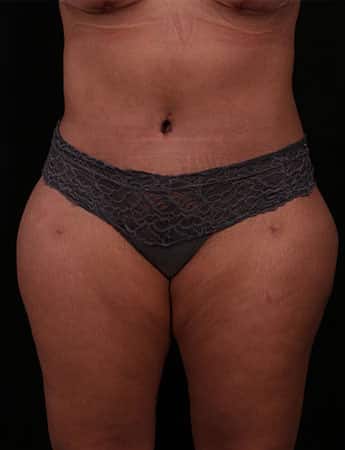 After Image: TUMMY TUCK (ABDOMINOPLASTY) - front