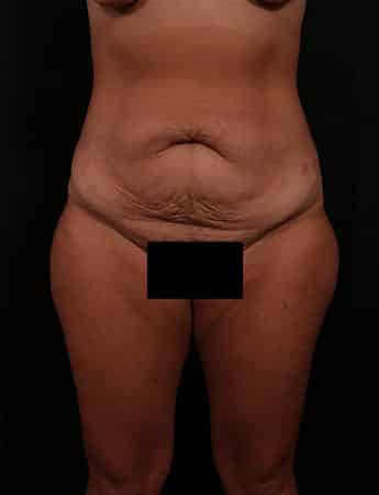Before Image: TUMMY TUCK (ABDOMINOPLASTY) - front
