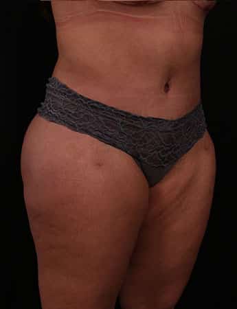 After Image: TUMMY TUCK (ABDOMINOPLASTY) - right-front-oblique