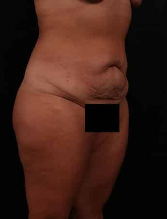 Before Image: TUMMY TUCK (ABDOMINOPLASTY) - right-front-oblique