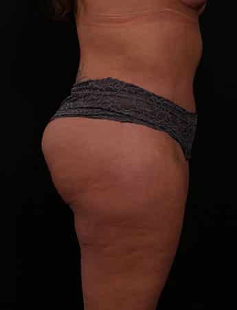After Image: TUMMY TUCK (ABDOMINOPLASTY) - right-side