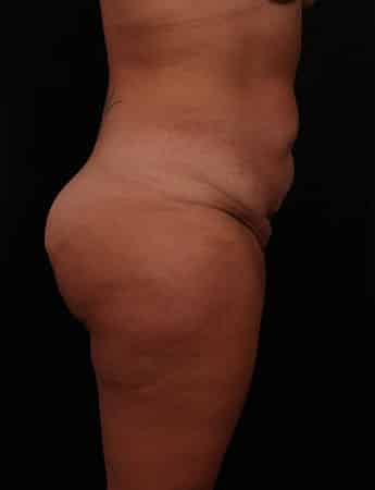 Before Image: TUMMY TUCK (ABDOMINOPLASTY) - right-side