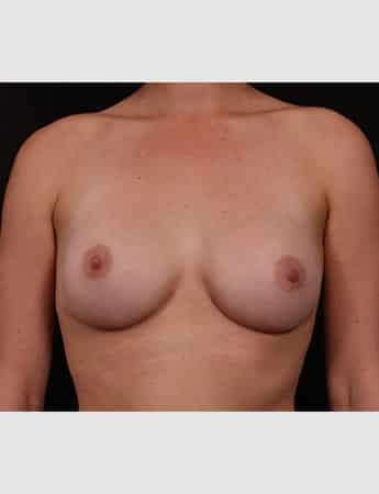 Secondary Breast Enhancement