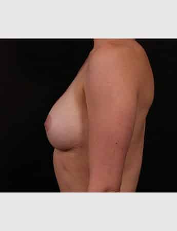 After Image: Secondary Breast Enhancement - left-side