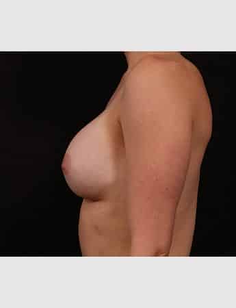 Before Image: Secondary Breast Enhancement - left-side