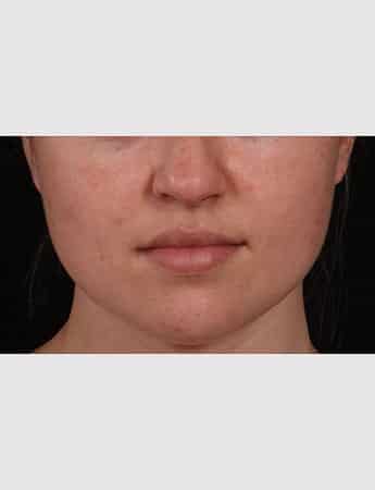 After Image: Buccal Fat Removal - front