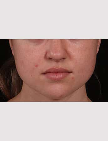 Before Image: Buccal Fat Removal - front