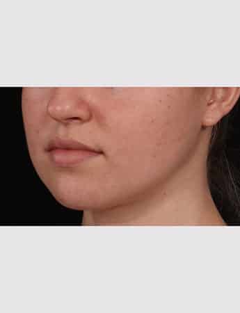 After Image: Buccal Fat Removal - left-front-oblique