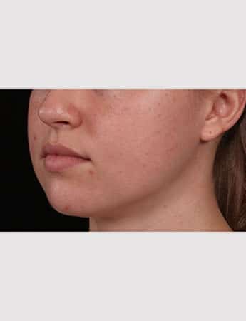 Before Image: Buccal Fat Removal - left-front-oblique
