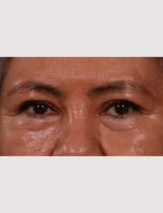 Upper Blepharoplasty