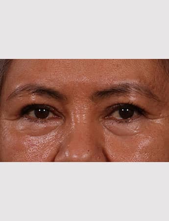 After Image: Upper Blepharoplasty - front