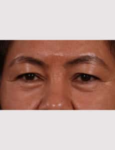 Upper Blepharoplasty